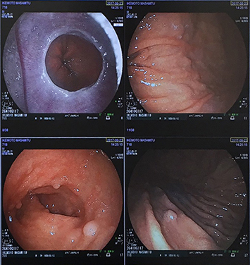 胃カメラ画像